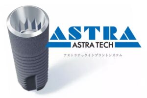 Astra Tech Implant（アストラテックインプラント）