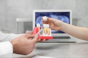 インプラントの模型で説明する医師