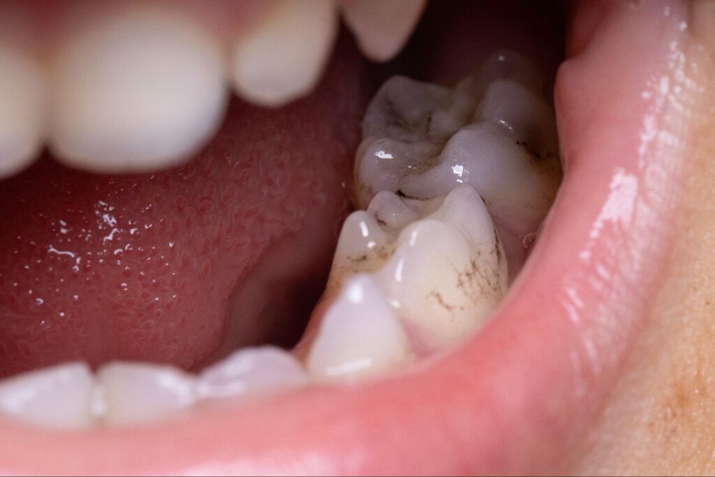 虫歯のある口腔内の写真