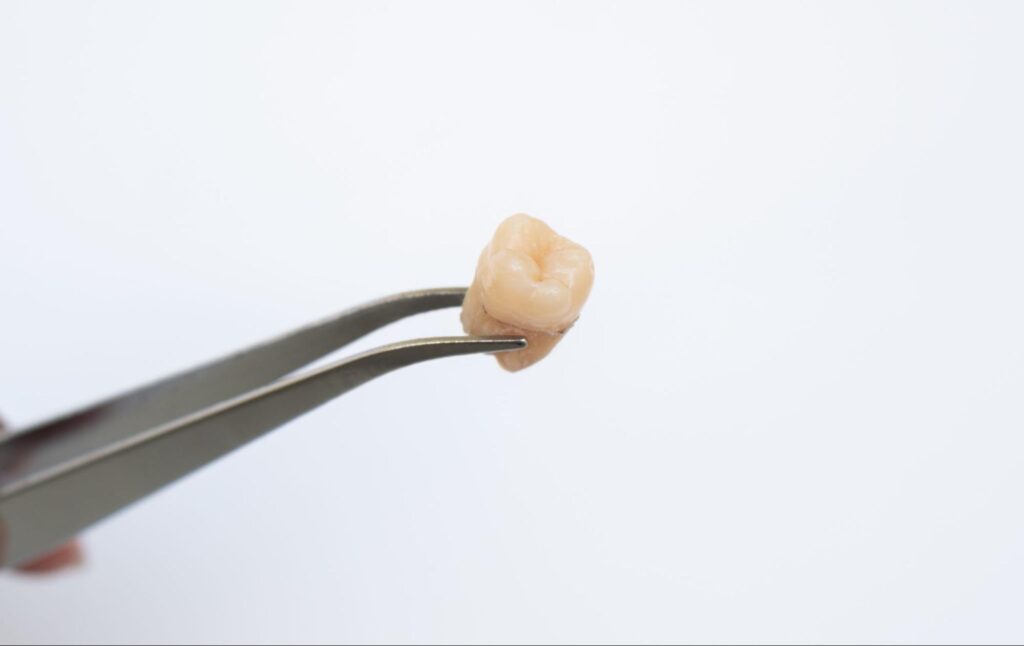 ピンセットで摘まれた抜歯後の親知らず