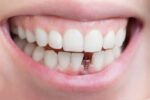 笑顔の白い歯の間にインプラントの土台（アバットメント）が見えている状態の人