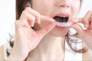 マウスピース矯正 痩せる