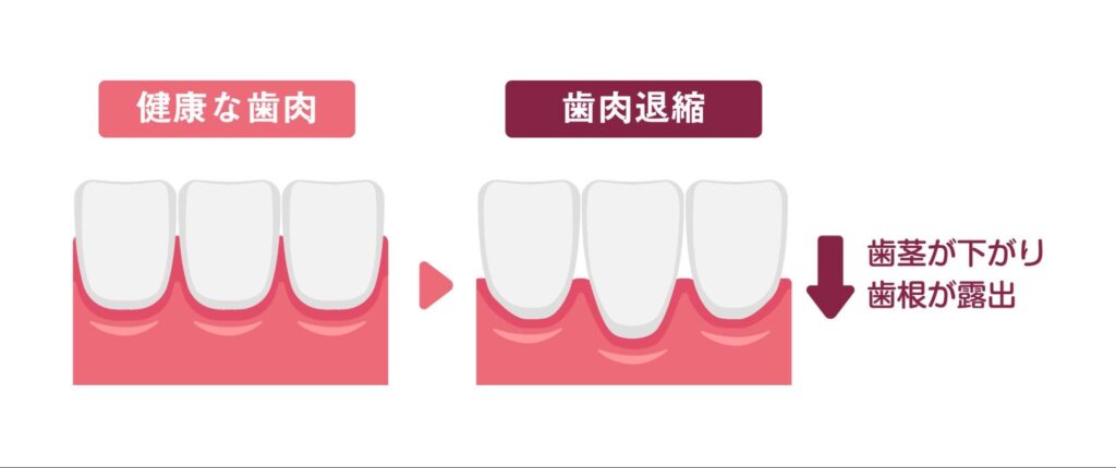 歯茎 下がる