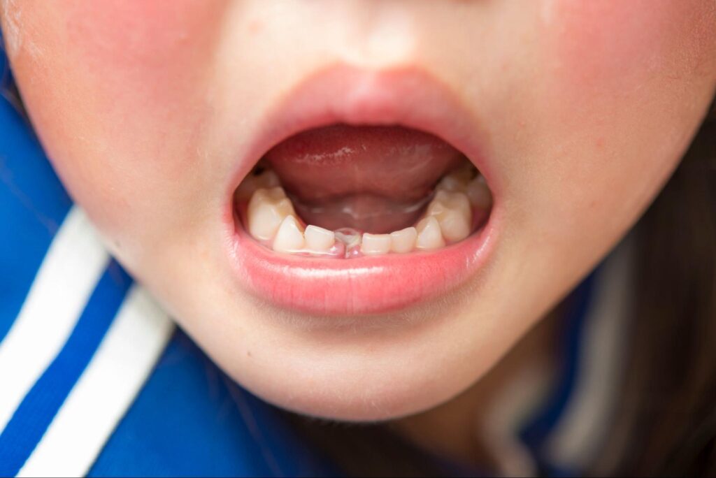 子ども 歯並び 自然に治る