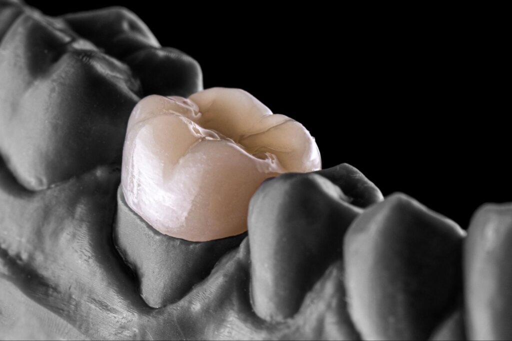 歯 被せ物 種類 おすすめ