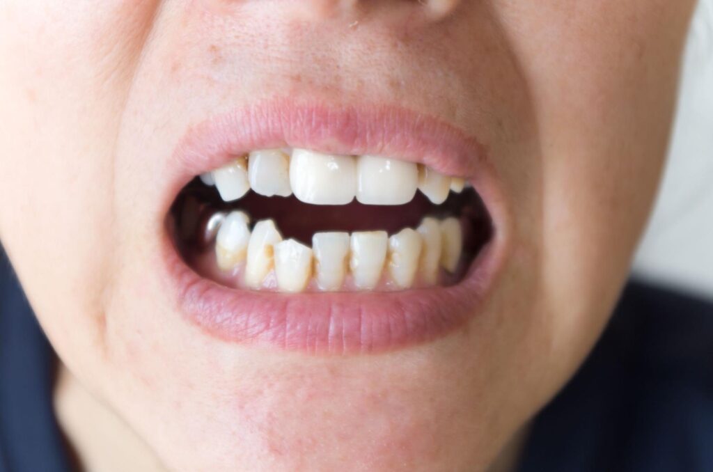 下の歯並びが悪くなってきた