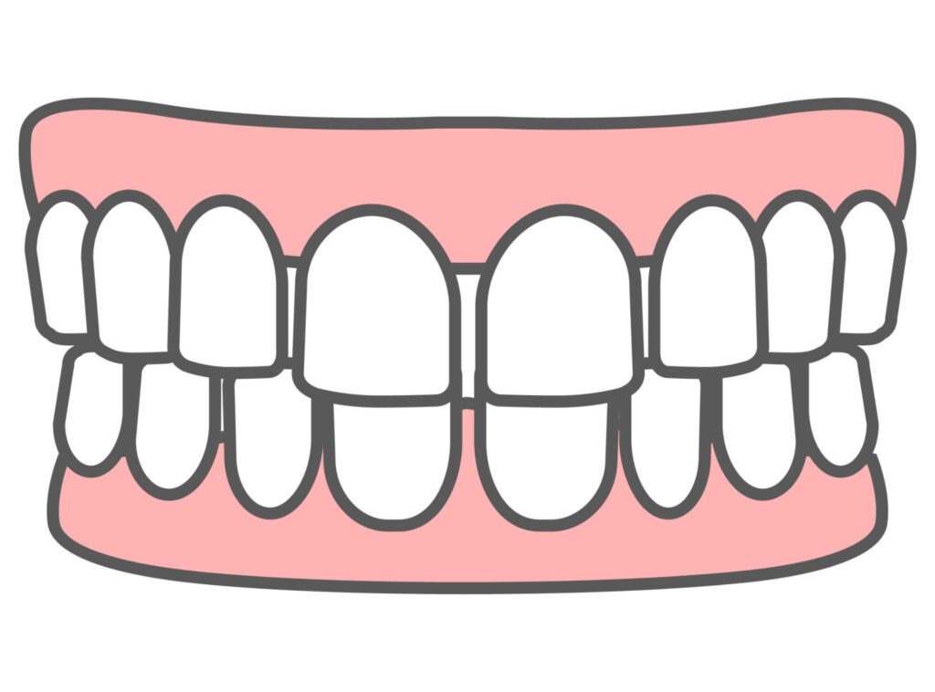矯正 隙間 埋まらない 終了