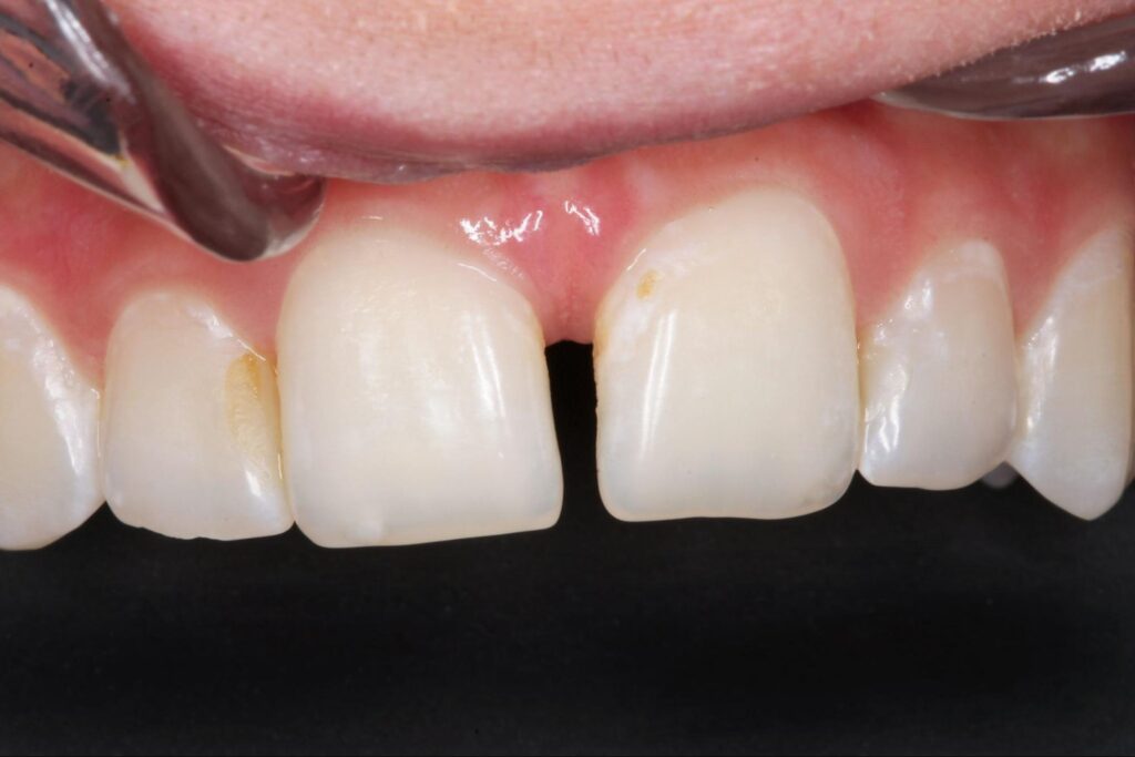 歯の隙間 埋める